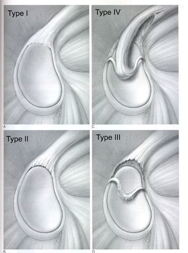 speed test slap tear|4 types of slap lesions.